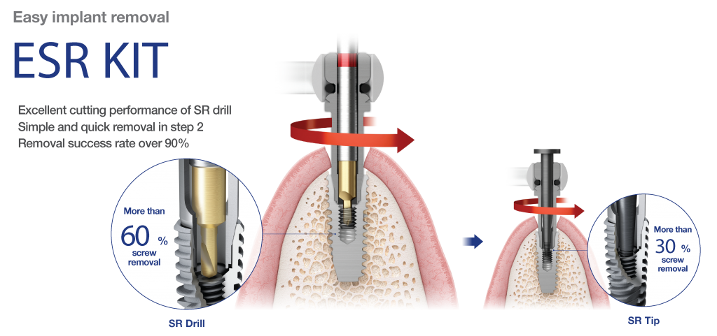 ESR Implant Removal Kit