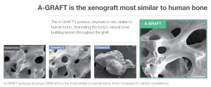 A-GRAFT is the xenograft most similar to human bone